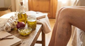 الثوم والبصل وزيت الزيتون لعلاج دوالي الأوردة