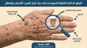 ماهي النقط السوداء التي تظهر على الجلد عند كبار السن فوق ال ٥٠ عام ؟